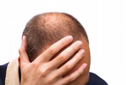 Mental strain of hair loss Mental strain of hair loss