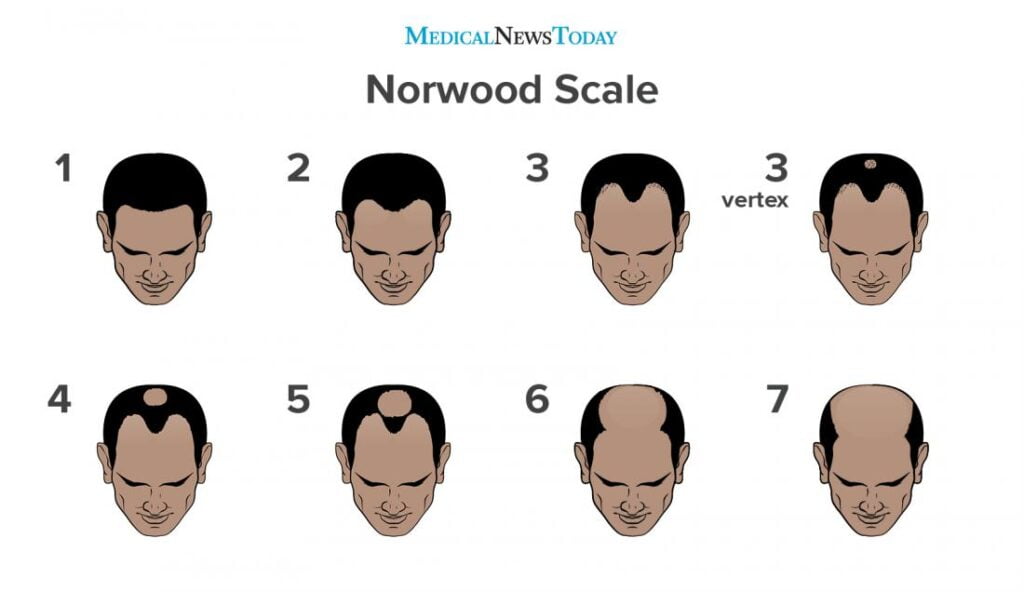 Norwood Scale Norwood Scale