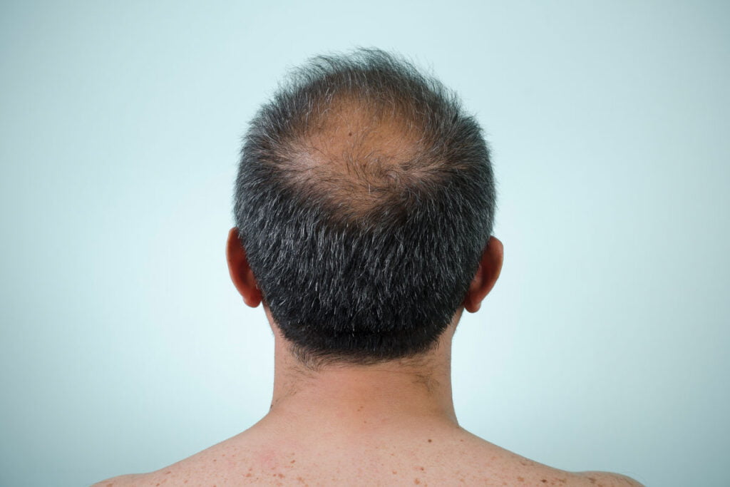 Bald spot on crown of head Bald spot on crown of head